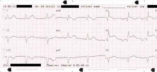 atrial fibrillation ivcd