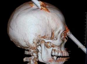 AP Photo/Miguel Couto HospitalThis tomography scan shows the skull of 24-year-old construction worker Eduardo Leite in Rio de Janeiro, Brazil. Doctors say Leite survived after a 6-foot metal bar fell from above him and pierced his head. Doctors successfully withdrew the iron bar during a five-hour-long surgery.