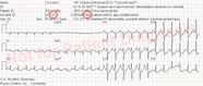 ECG Solution Get To The Point 