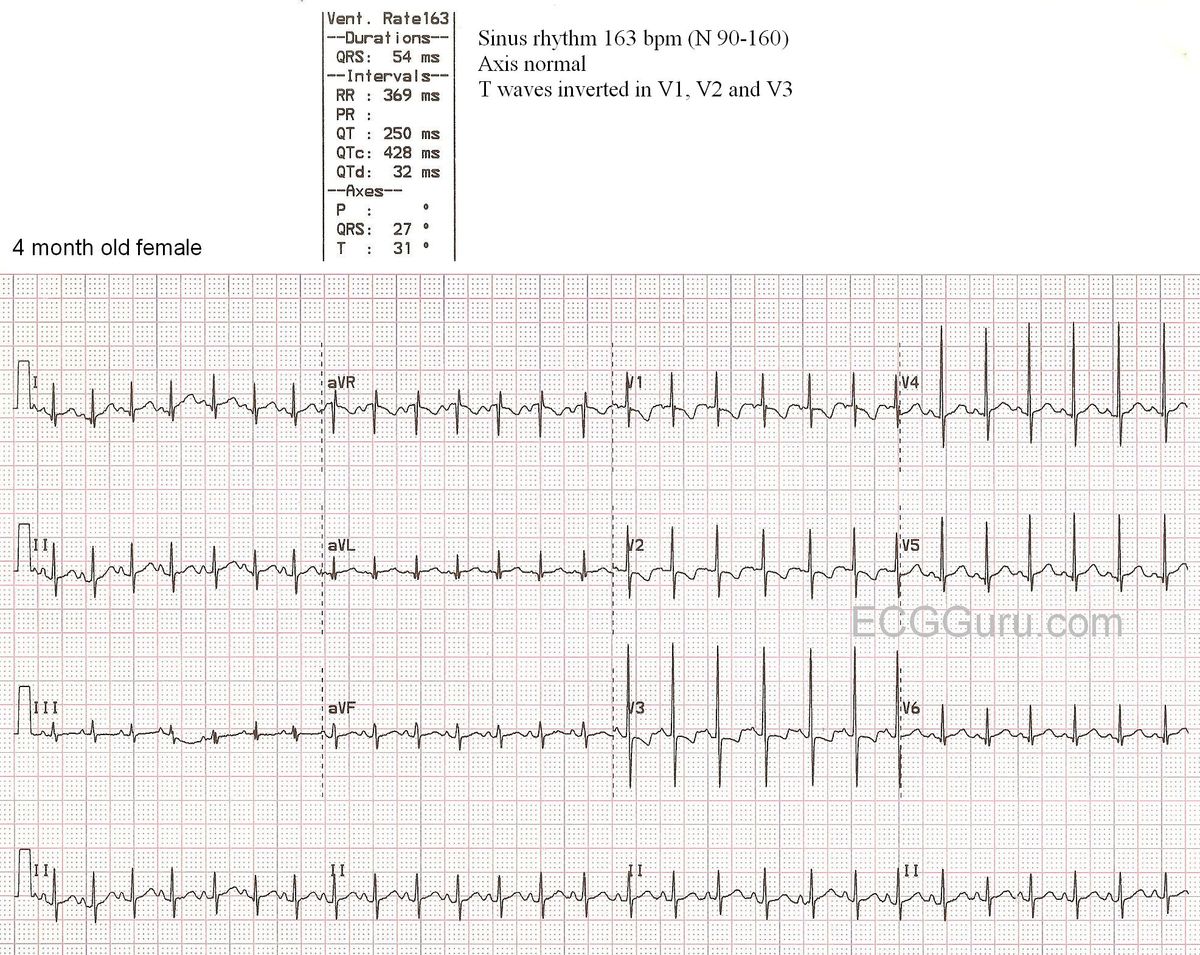 Introduction to pediatric ECG