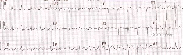 10 Tips To Never Miss Atrial Flutter With 2 1 Conduction