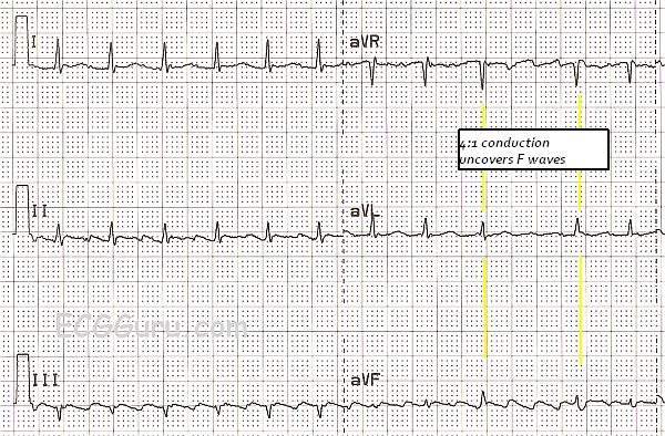 10 Tips To Never Miss Atrial Flutter With 2 1 Conduction