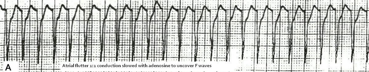 10 Tips To Diagnose Atrial Flutter On An Ekg