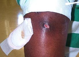 This 2005 photograph depicted a cutaneous abscess on the knee of a prison inmate, which had been caused by methicillin-resistant Staphylococcus aureus bacteria, referred to by the acronym MRSA. (CDC photo)