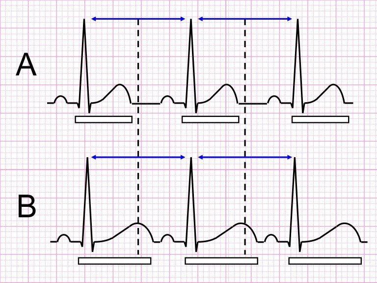 Qtc Example ECG Solution – Get to the point!