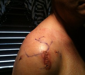 Shoulder surgery is all-too-common among middle-aged men. Re-attaining one’s shooting skills can be a challenge.