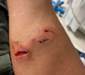 An Alabama deputy was wounded after a suspect clamped down on the deputy's arm with his teeth, said the Walker County Sheriff's Office.