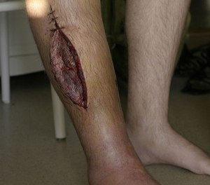 Fasciotomy is the surgical procedure normally used to treat certain types of compartment syndrome. (Photo/Wikipedia)
