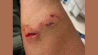 Man 'bites hole in deputy’s arm,' Ala. cops say