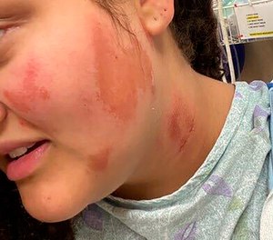This photo shows the burns on Madison EMT Althea Bernstein's face and neck after she says four white men sprayed her with lighter fluid and threw a lighter at her, setting her on fire as she was driving in downtown Madison, Wis. (Photo/Courtesy of family of Althea Bernstein via AP)