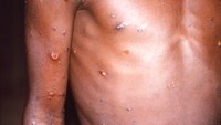 CDC monitoring potential monkeypox cases in U.S.