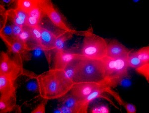 This undated fluorescence-colored microscope image made available by the National Institutes of Health in September 2016 shows a culture of human breast cancer cells.