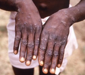 While some individuals will experience the entire spectrum of monkeypox symptoms, others may only experience the tell-tale rash.