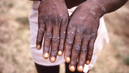 What EMS should know about monkeypox patient care and provider safety