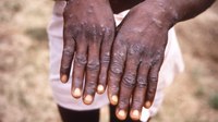 Monkeypox gets new name after ‘racist and stigmatizing language,’ health officials say