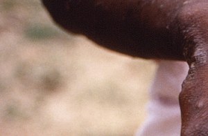 This 1997 image provided by the CDC during an investigation into an outbreak of monkeypox, which took place in the Democratic Republic of the Congo depicts the dorsal surfaces of the hands of a monkeypox patient with the characteristic rash during its recuperative stage.