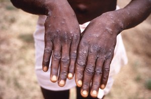 Monkeypox, renamed mpox, results in a rash that can cover various parts of the body, including hands, feet, face, mouth or genitals, according to the CDC.