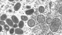 U.S. expands monkeypox testing; CDC confirms 156 cases