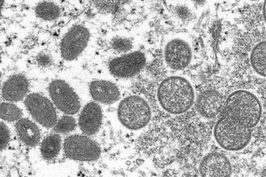 Monkeypox typically causes flu-like symptoms before progressing to a rash on the face and body.
