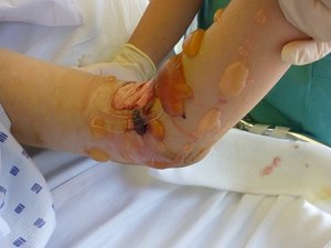 Acute compartment syndrome with blister formation (Photo/Wikimedia Commons) 