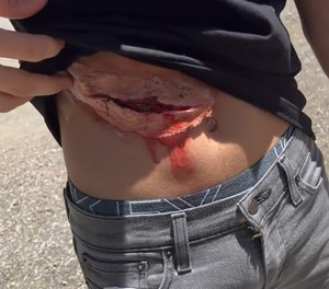 A participant shows their simulated abdominal injury.