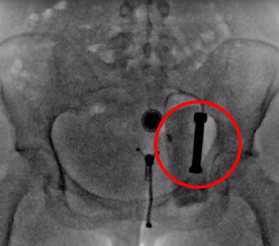 does hiding contraband in your butt work when pulled over by the police?