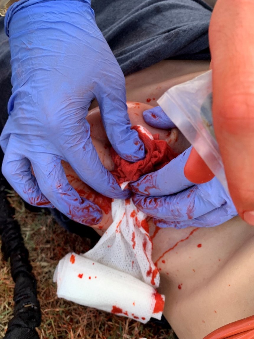 Proper wound packing includes stuffing hemostatic gauze or cloth down into the wound where the bleeding is occurring. Pack as much of the gauze into the wound as you can and then apply firm direct pressure.