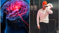 Ramsay Hunt syndrome vs. stroke