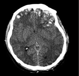 icd 10 code soft tissue swelling front cranium right