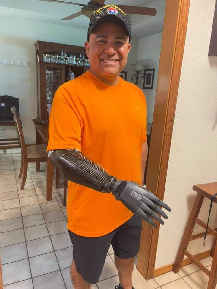 Eddy pictured with his state-of-the-art robotic titanium prosthetic arm.