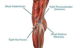 Over time, because we sit too much and because we have done improper exercises like crunches and leg raises, our hip flexors become tight. As they become tight, they pull the pelvis forward and as the pelvis is pulled forward some interesting things happen. (Image courtesy of Bryan Fass)
