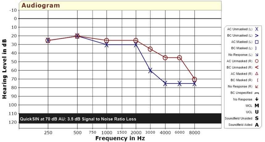 This chart shows the result of a hearing exam. Note the loss in the left ear (blue).