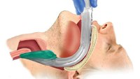 Should the EMT scope of practice include supraglottic airway placement?