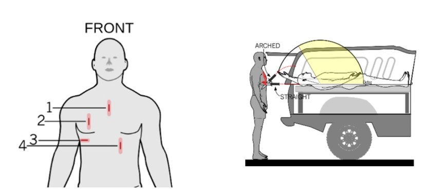 One of the fatal blows was a deep thrust that punctured the sternum and went into the heart.