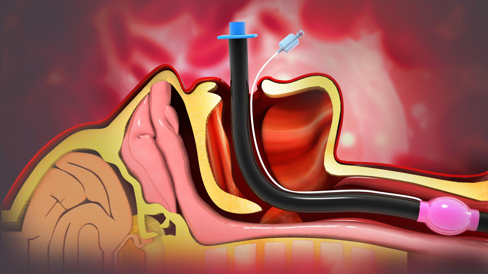 Podcast: Airway management tips, techniques and tools Podcast: Airway management tips, techniques and tools