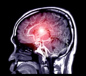 The results of the study, published in JAMA Neurology this week, found that stroke patients were more likely to receive endovascular therapy at comprehensive stroke centers in comparison to the nearest stroke center to the patient.