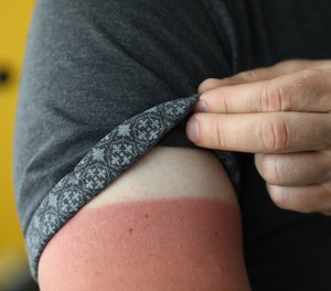 For those with lower levels of melanin, prolonged unprotected sun exposure causes skin cells in the epidermis (your skin’s surface) to become red, swollen and painful – aka sunburn.