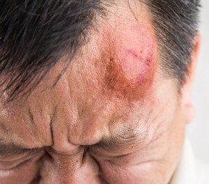 Despite the increased interest in the public setting, the fire service remains unprepared for the unique risks of head injuries on scene and their consequences off scene.