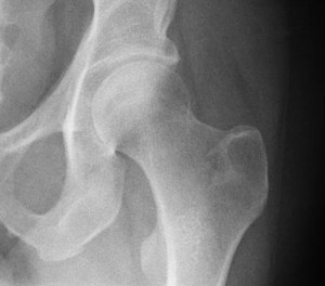Prehospital providers frequently encounter patients with various fractures and related injuries. What might be surprising is some orthopedic injuries are recognized by specific medical designations.
