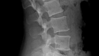 Are your clinicians ready to clear C-spine in the field?