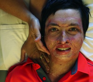 Daniel Lyon Jr., a firefighter badly burned in the 2015 Twisp wildfire, is seen here during physical therapy, in July 2016. (Ken Lambert/The Seattle Times/TNS)