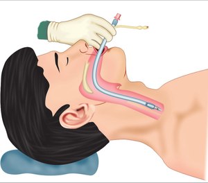 Three well-known experts took to the stage at the National Association of EMS Physicians (NAEMSP) Annual Meeting to summarize recent research and advocate for and against paramedic endotracheal intubation