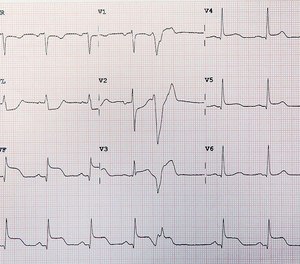 Like other HIRTSC, clinical outcomes for STEMI are improved when definitive care is initiated as soon as possible.