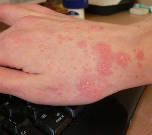 Scabies is a contagious condition stemming from mites burrowing under the skin, which leads to itching and rashes. (Photo/Wikimedia Commons)