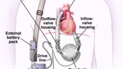 The arresting LVAD patient: A review of the updated recommendations