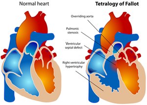 Tetralogy of Fallot is a congenital heart defect that has four features.