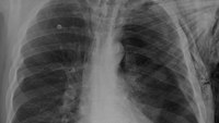 Tension pneumothorax: How capnography and ultrasound can improve care