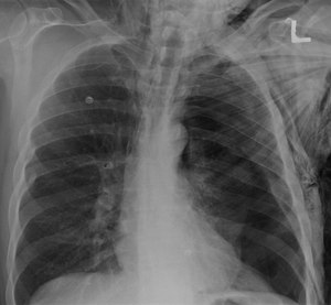 Definitive treatment for a pneumothorax is a chest tube, though a small pneumothorax may resolve on its own.