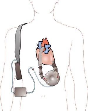A left ventricular assist device (LVAD) pumping blood from the left ventricle to the aorta, connected to an externally worn control unit and battery pack.