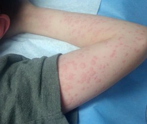 An anaphylactic reaction to a bee sting.